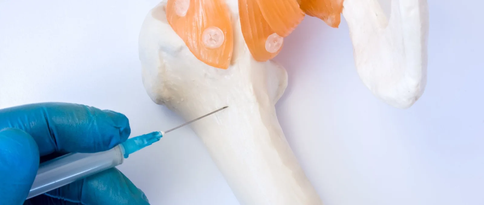 Jak wygląda przeszczep szpiku kostnego